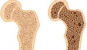 Imagem ilustrativa de um osso normal e outro com osteoporose