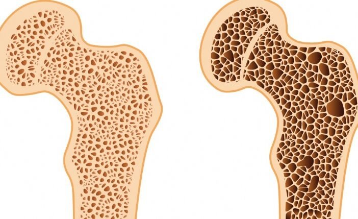 Imagem ilustrativa de um osso normal e outro com osteoporose